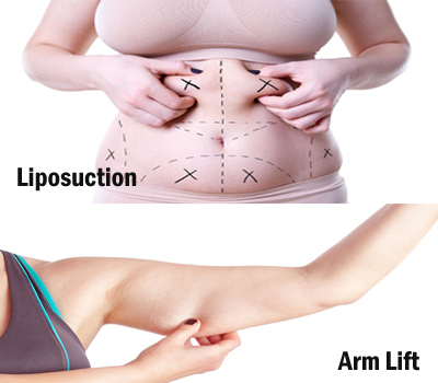 Liposuction / Arm Lift