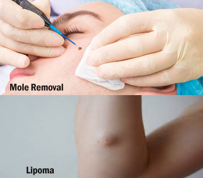 Skin Lipomas / Moles Removal