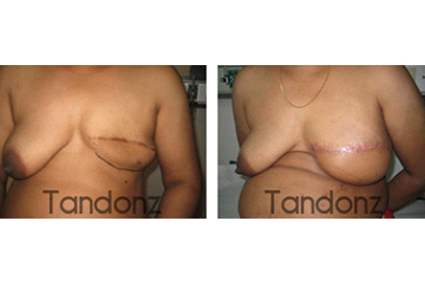 Breast Reconstruction