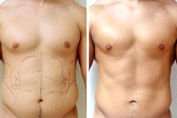 Abdominal Etching ( Six Pack Abs)