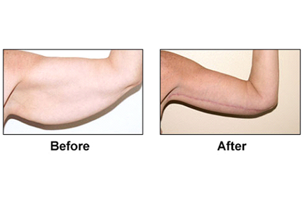 Arm Lift
