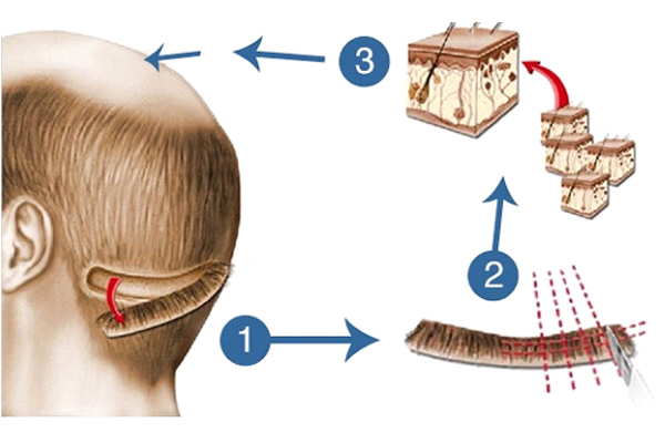 Hair transplantation