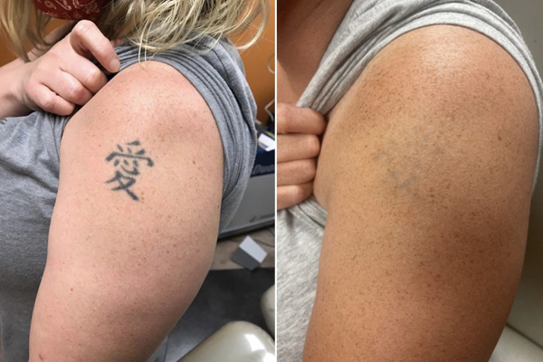 Tatto Removal
