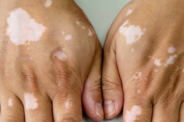 Vitiligo 