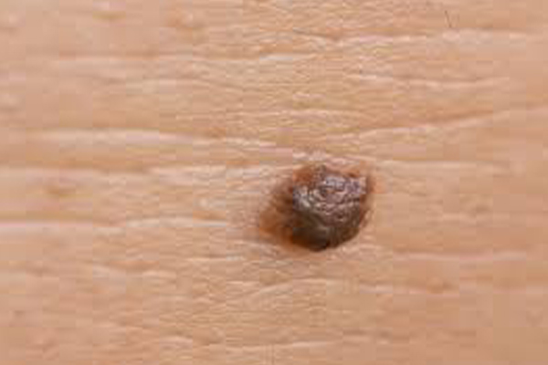 Moles Removal