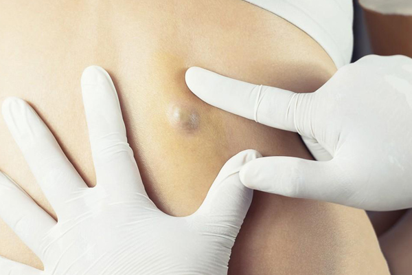 Cyst 