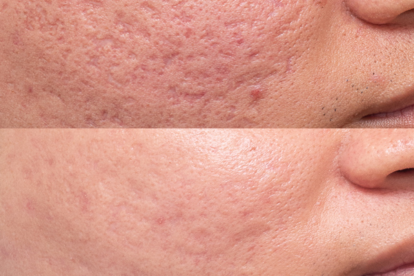 Acne Scars 