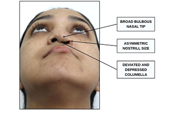 Cleft lip and Nose Deformity