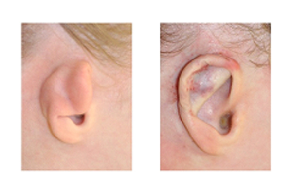 Ear Deformities 