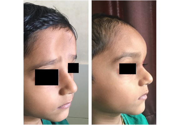  Depression Forehead