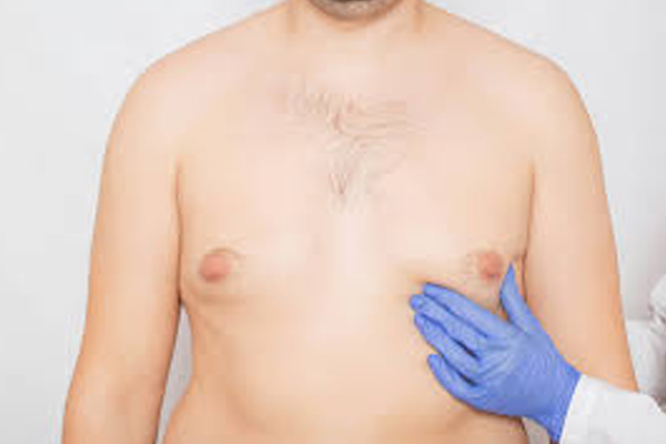  Male Breast Reduction (Gynecomastia) 