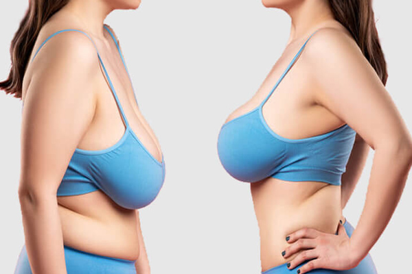 Female Breast Reduction Surgery