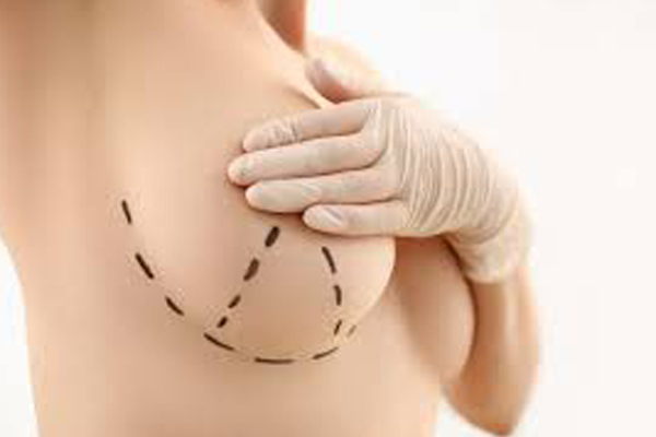 Breast Lift (Mastopexy)