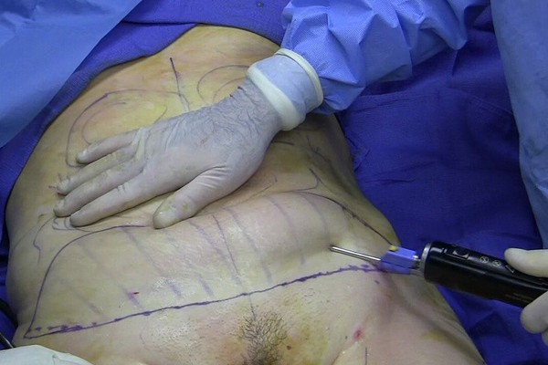 Liposuction