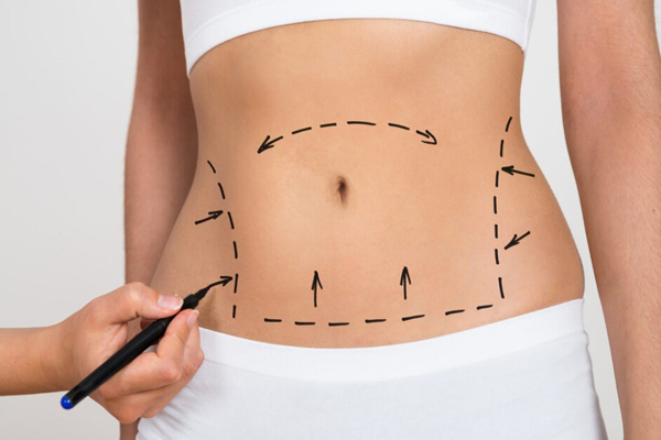 Abdominoplasty  or  Tummy Tuck or Mommy Makeover